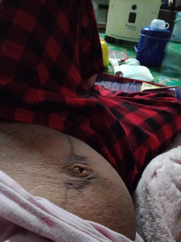 แม่ๆคะหลังคลอดท้องเป็นแบบนี้