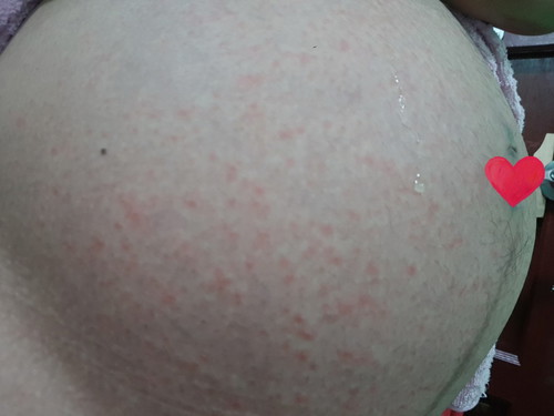 ผื่นคัน