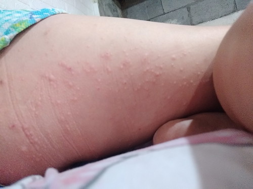Rashes