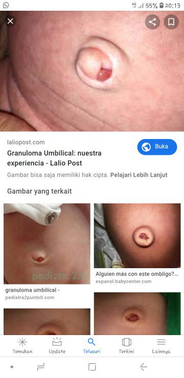 Granuloma