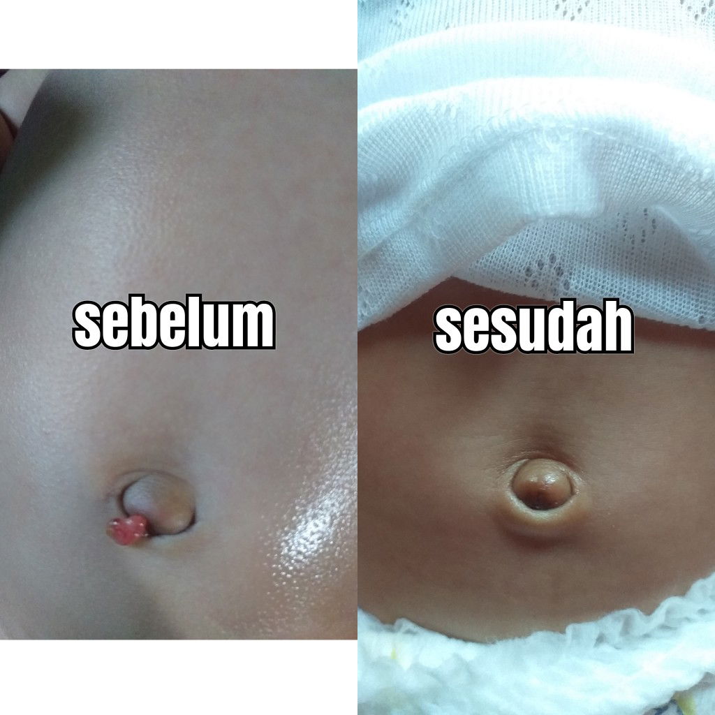 Granuloma Umbilicalis