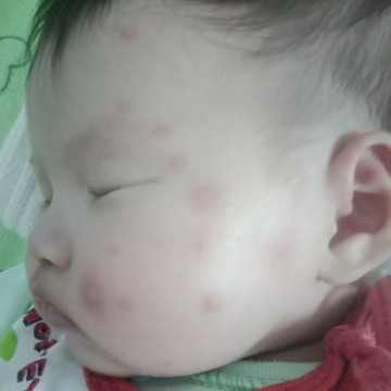 น้องเป็นตุ่มแดง