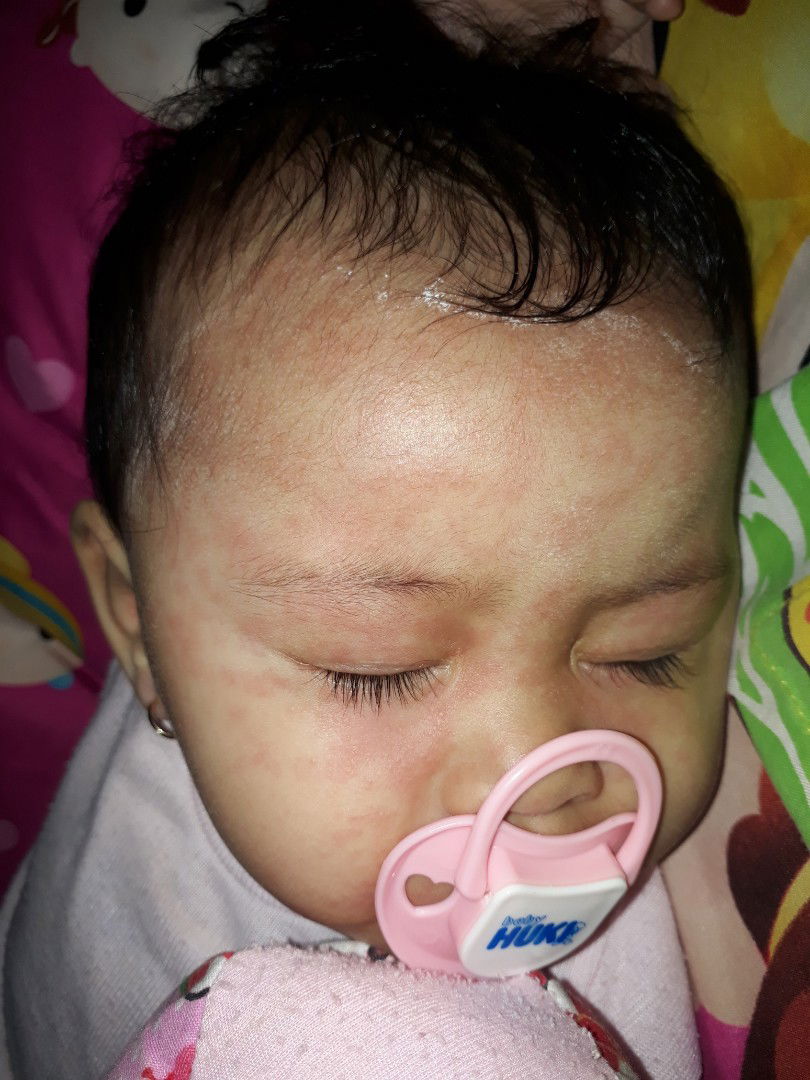 kulit merah2 pada bayi