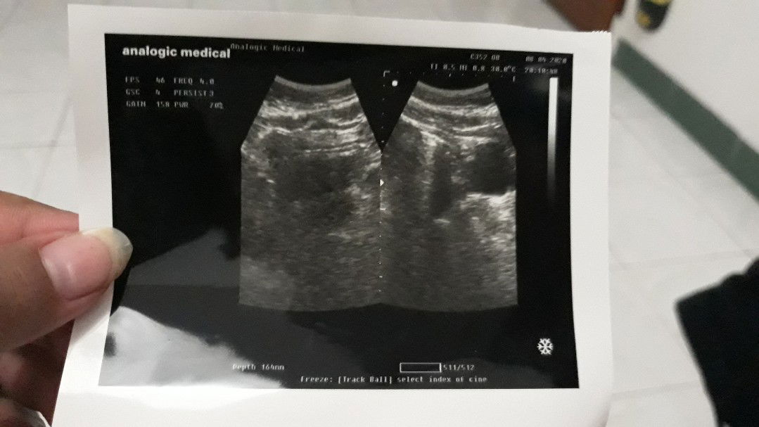 cara baca USG gimana sih hehehe