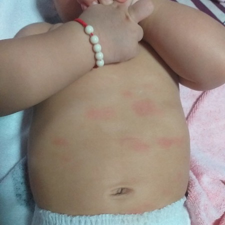 หน้าท้องเป็นแดงๆจ้ำๆ