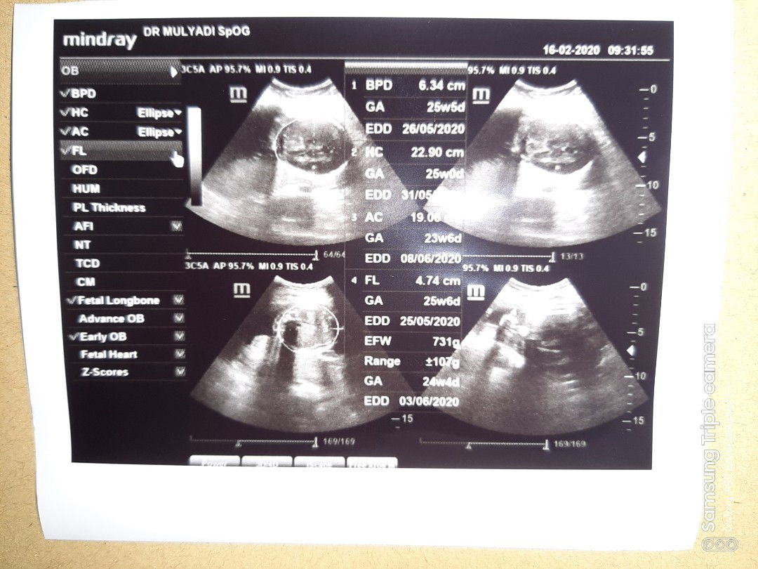 normalnya BBJ itu berapa si bun ?