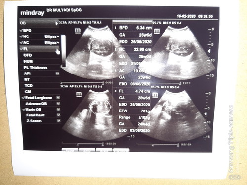 normalnya BBJ itu berapa si bun ?