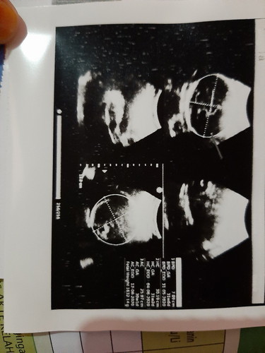 jadi Udh masuk brpa Week ya bun , soalnya itungan dokter SPOG dan HPHT saya beda , jadi bnggung (?) ?