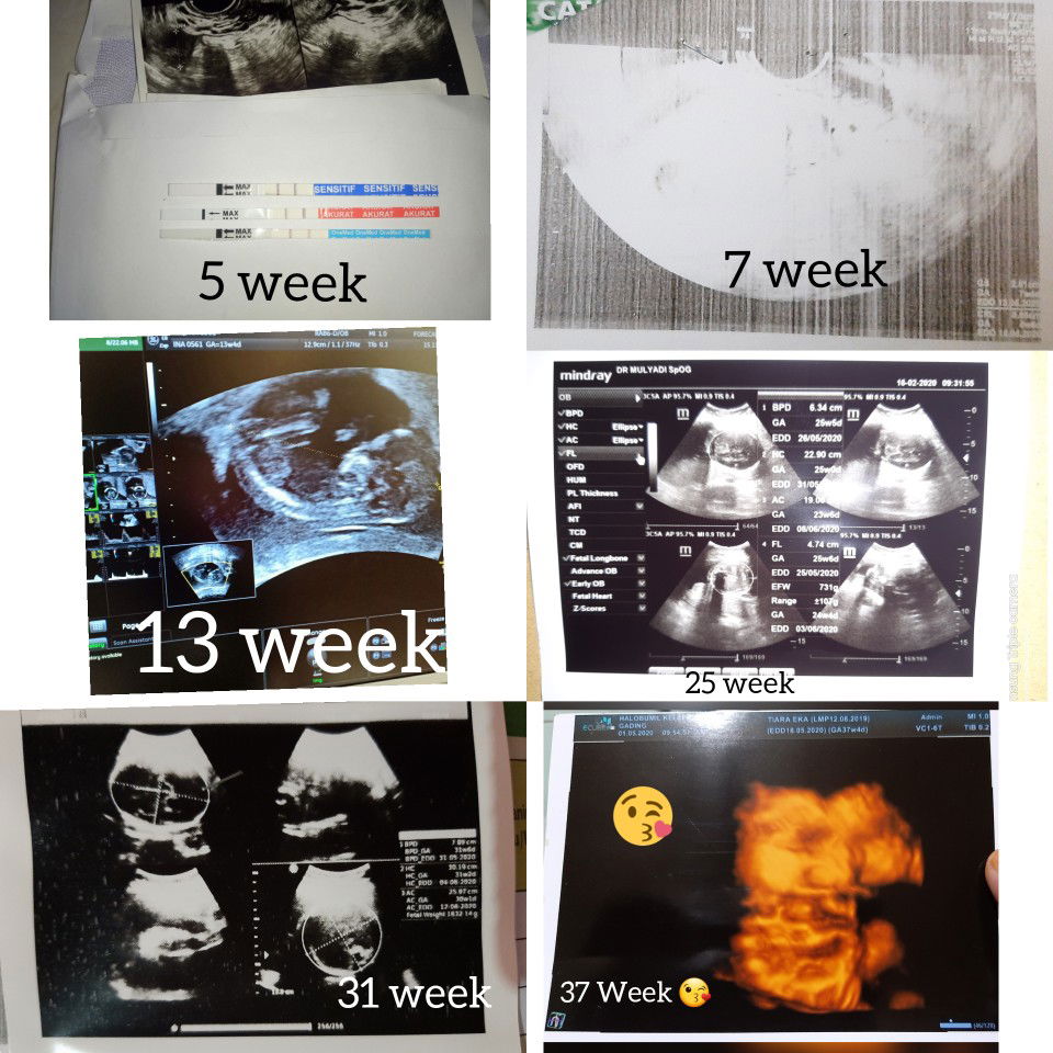 menunggu malaikat kecil itu segera lahir kedunia ???