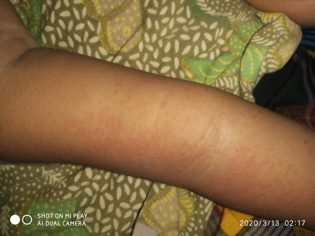 tangan anak saya pada kemerahan