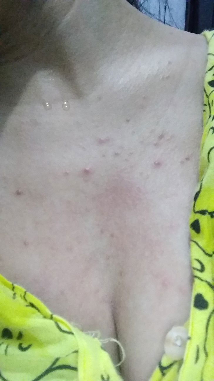 Ada gak disini bunda² yg selama Hamil kulit nya gatel² gampang keringetan. saya lgi hamil trimester ketiga gampang banget keringetan,kulit dibagian dada Gatel dan perih banget, udah coba di olesin bedak salicyl tetep aja gatel,Kalo kena keringat makin per