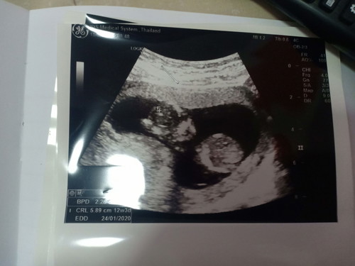 ขอดูรูปอัลตราซาวด์ของคุณแม่4เดือนหน่อยคะ