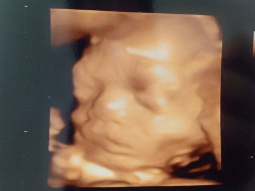 ท้อง7เดือน