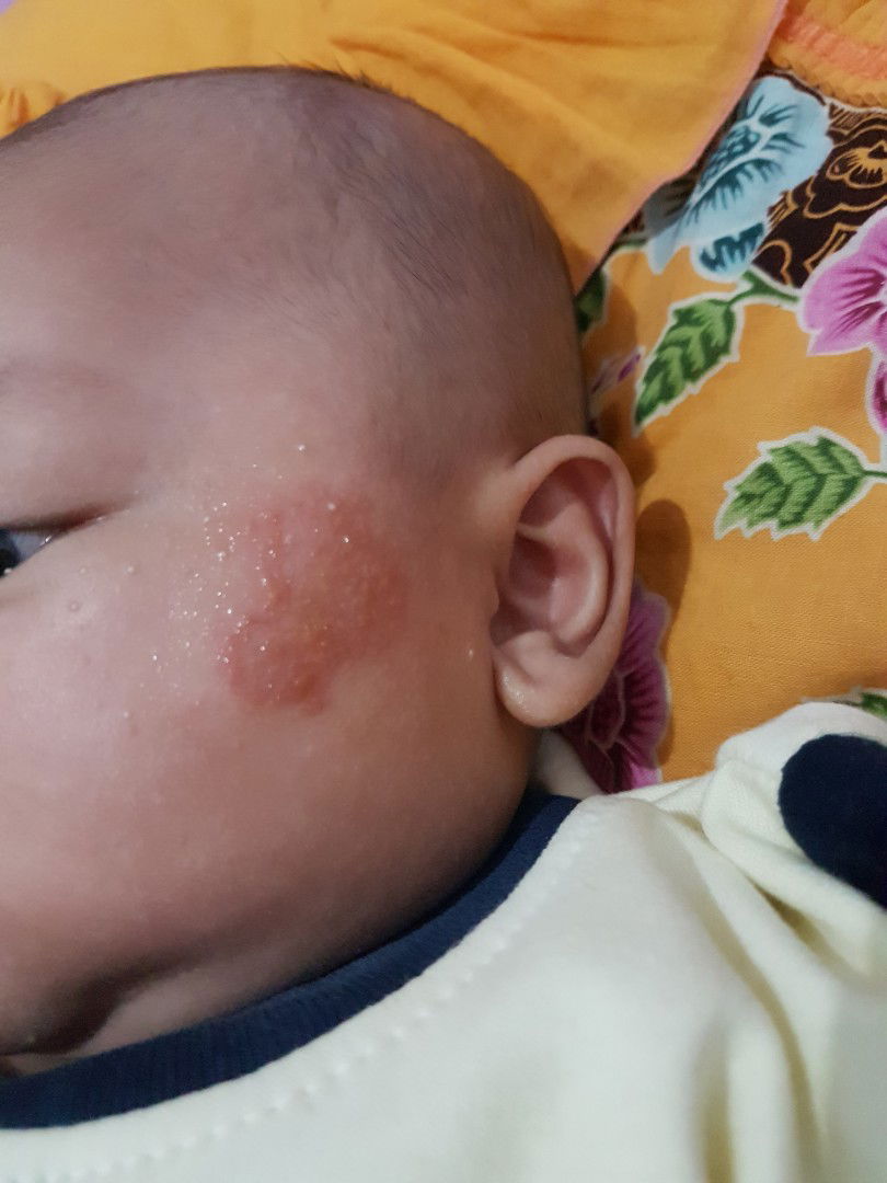 ruam wajah pada bayi