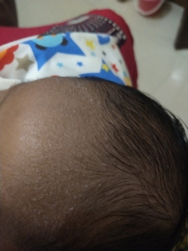 Bruntusan di jidat bayi