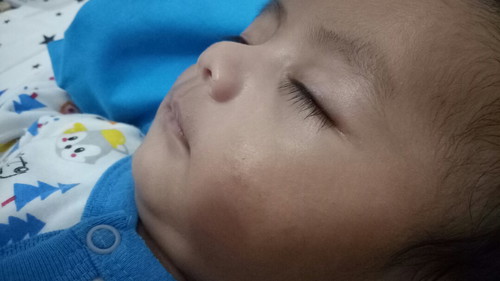 Pipi bintik putih dan kasar