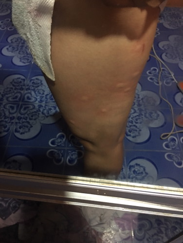 คนท้องโดนยุงกัดเป็นไรไหม