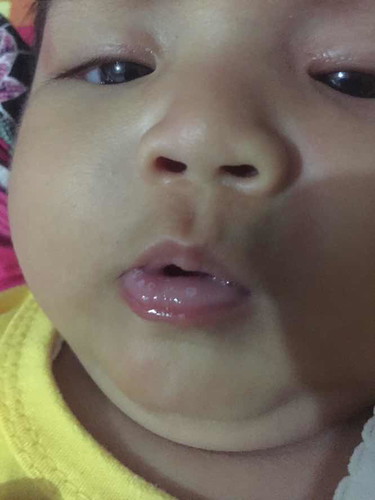 Putih pada bibir
