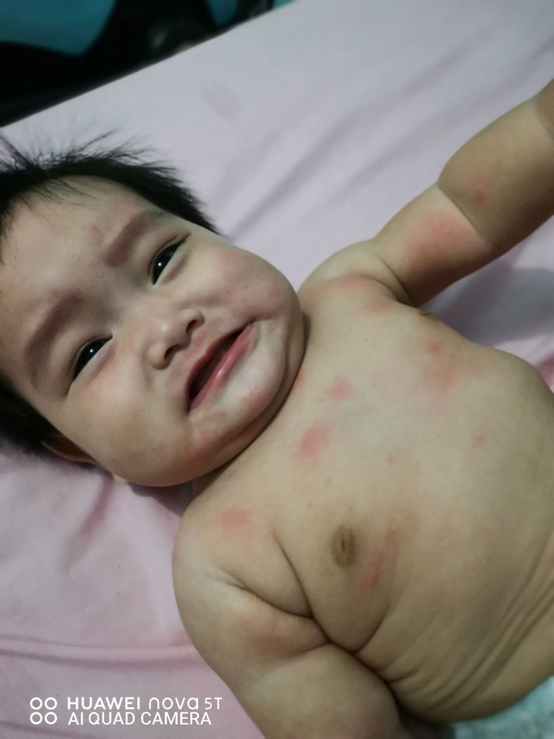 Baby 6 Months Alergic-fully Breastfeed