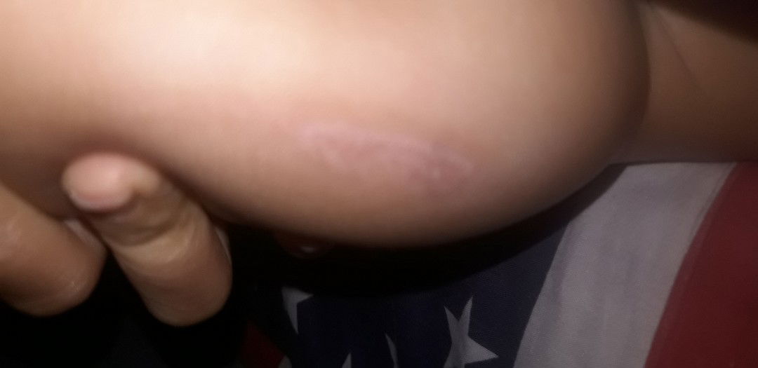 obat hilangin bekas luka