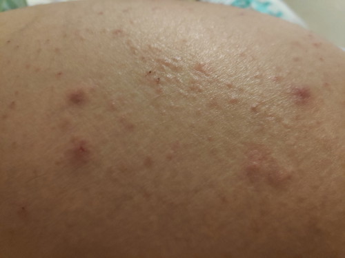 lot rashes