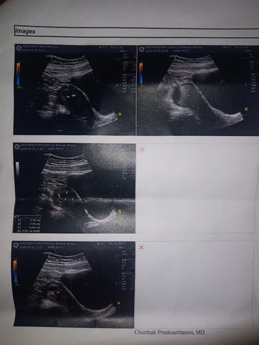 เลือดออกตอน 6w6d