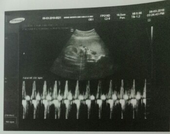 face or fetal heart beat???