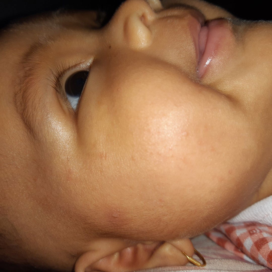 alergi sufor atau bukan