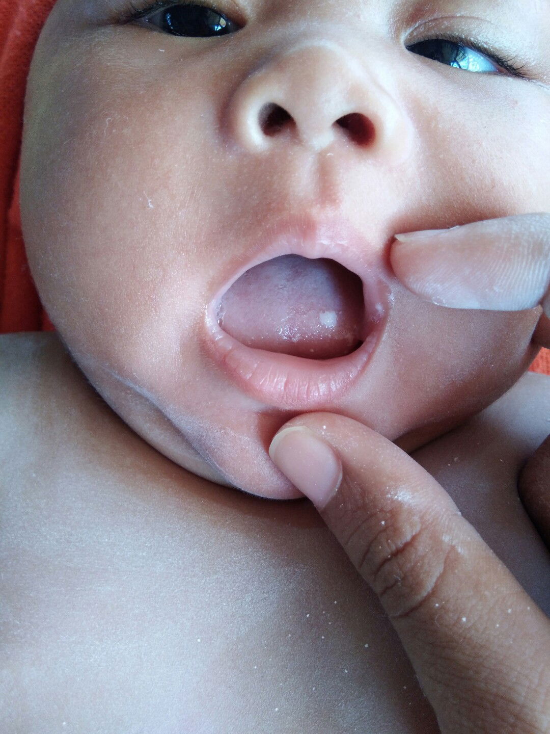 คราบสีขาวเกาะตามกระพุ้งแก้มและลิ้น