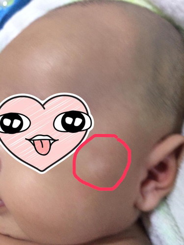 kurap pada bayi ?