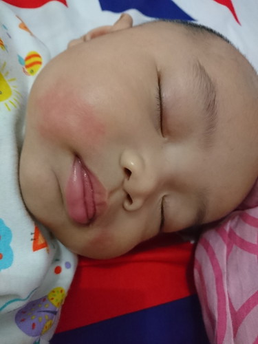 pipi merah apakah alergi ?
