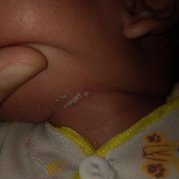 Putih2 di leher bayi