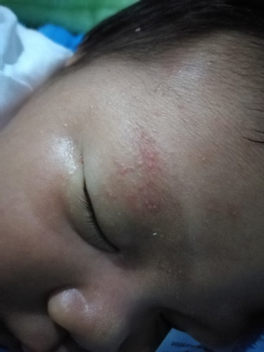 ผื่นที่หน้าทารก