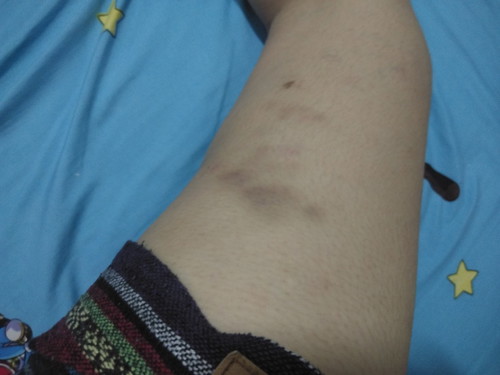 ขาช้ำเหมือนโดนกระแทก