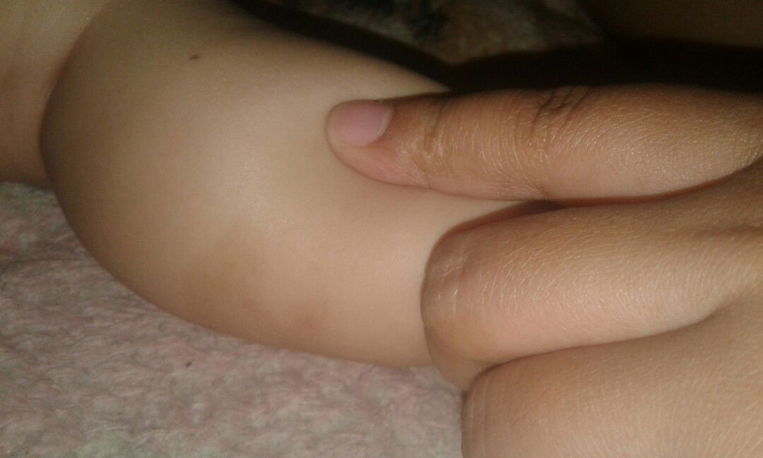 bekas digigit nyamuk