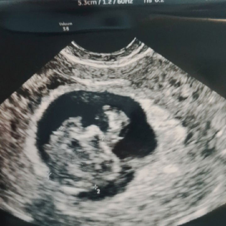 ฝากครรตอนท้องได้7สัปดาห์