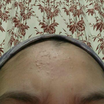 Cara mengatasi bruntusan parah