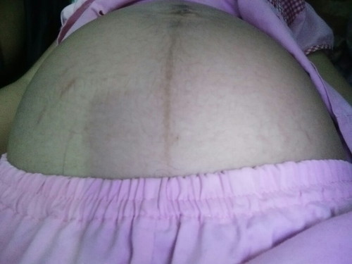คันท้อง ท้องแตกลาย