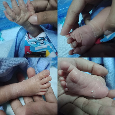 มือ เท้า ลอก