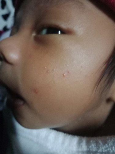 สิวหรือผื่น