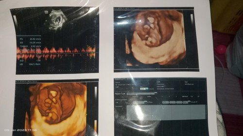 Assalamualaikum Bun,mau tanya cara liat djj bayi sama berat bayi yang mna ya Bun?lupa soalnya🙏