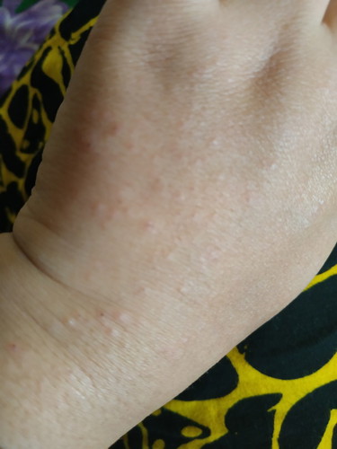 tangan bintik2 gatal