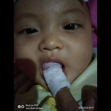 noda putih dilidah bayi yang membandel