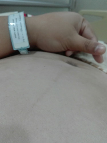 ครรภ์เป็นพิษ