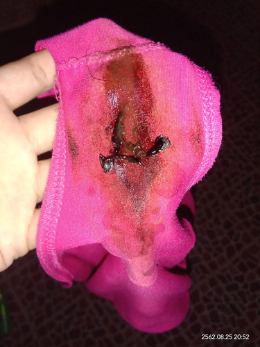 มีเลือดออก?