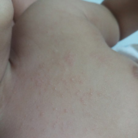 ผื่นขึ้นหน้าอก