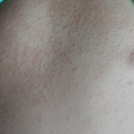 ลูกใครเป็นบ้างผื่นขึ้นมา10วันแล้วมีวิธีแก้ไหมคะ