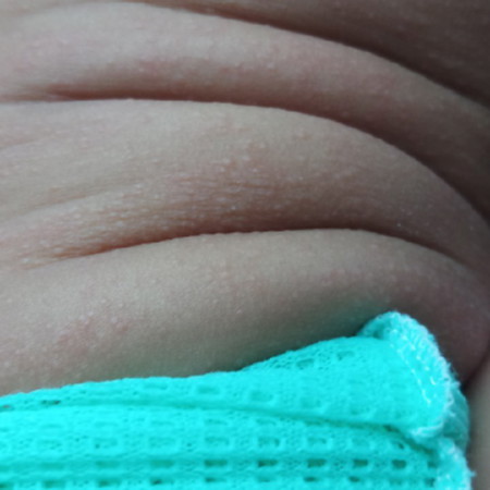 ลูกใครเป็นผื่นบ้างมีวิธีแก้ไหมคะ