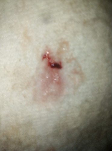 เลือดออก