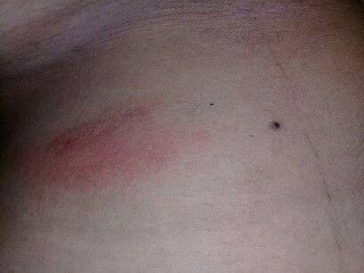 ruam merah pada kulit